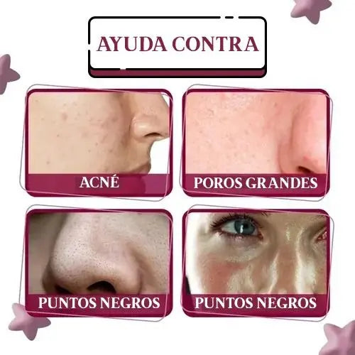 Sérum Facial AHA 30% + BHA 2% | Exfoliante Químico Anti Acné, Manchas y Puntos Negros. ENVÍO GRATIS